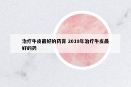 治療牛皮最好的藥膏 2019年治療牛皮最好的藥