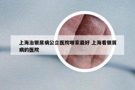 上海治銀屑病公立醫(yī)院哪家最好 上海看銀屑病的醫(yī)院