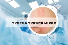牛皮蘚吃什么 牛皮皮癬吃什么水果最好
