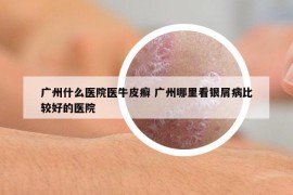 廣州什么醫(yī)院醫(yī)牛皮癬 廣州哪里看銀屑病比較好的醫(yī)院