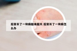 后背長了一塊癬越來越大 后背長了一塊癬怎么辦