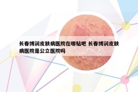 長春博潤皮膚病醫(yī)院在哪貼吧 長春博潤皮膚病醫(yī)院是公立醫(yī)院嗎