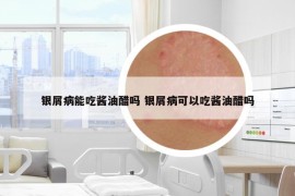 銀屑病能吃醬油醋嗎 銀屑病可以吃醬油醋嗎