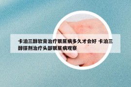 卡泊三醇軟膏治療銀屑病多久才會(huì)好 卡泊三醇搽劑治療頭部銀屑病觀察