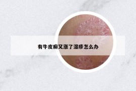 有牛皮癬又漲了濕疹怎么辦
