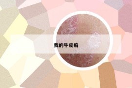 我的牛皮癬