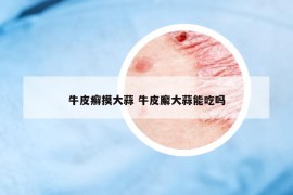 牛皮癬摸大蒜 牛皮廨大蒜能吃嗎
