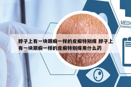 脖子上有一塊跟癬一樣的皮癬特別癢 脖子上有一塊跟癬一樣的皮癬特別癢用什么藥