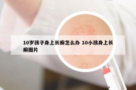 10歲孩子身上長癬怎么辦 10小孩身上長癬圖片