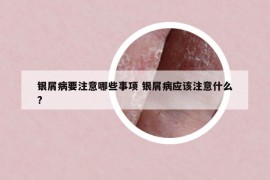 銀屑病要注意哪些事項(xiàng) 銀屑病應(yīng)該注意什么?