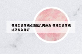 尋常型銀屑病點滴狀幾天痊愈 尋常型銀屑病抹藥多久能好
