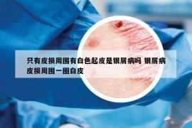只有皮損周圍有白色起皮是銀屑病嗎 銀屑病皮損周圍一圈白皮