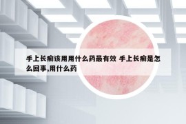手上長癬該用用什么藥最有效 手上長癬是怎么回事,用什么藥