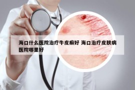 海口什么醫(yī)院治療牛皮癬好 ?？谥委熎つw病醫(yī)院哪里好