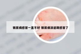 銀屑病感冒一直不好 銀屑病消退期感冒了