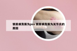銀屑病發(fā)展為psa 銀屑病發(fā)展為關節(jié)炎的原因