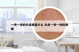 一塊一塊的頭皮癬是什么 頭皮一塊一塊的像癬