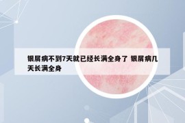 銀屑病不到7天就已經(jīng)長滿全身了 銀屑病幾天長滿全身