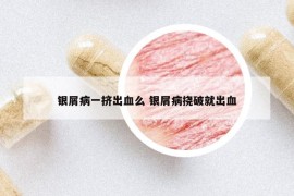 銀屑病一擠出血么 銀屑病撓破就出血