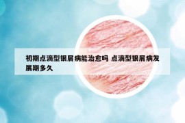 初期點(diǎn)滴型銀屑病能治愈嗎 點(diǎn)滴型銀屑病發(fā)展期多久