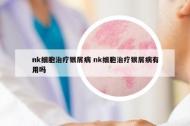 nk細胞治療銀屑病 nk細胞治療銀屑病有用嗎