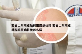 西安二附院皮膚科銀屑病住院 西安二附院皮膚科銀屑病住院怎么樣