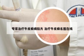 專家治療牛皮癬病驗方 治療牛皮癬名醫(yī)在線