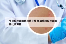 牛皮癬吃鹽酸特比萘芬片 銀屑病可以吃鹽酸特比萘芬片