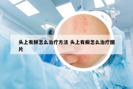 頭上有鮮怎么治療方法 頭上有癬怎么治療圖片
