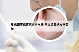 重慶銀屑病醫(yī)院咨詢電話 重慶銀屑病治療醫(yī)院