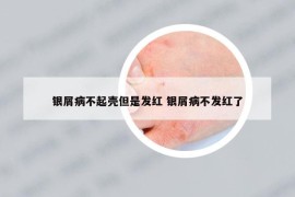 銀屑病不起殼但是發(fā)紅 銀屑病不發(fā)紅了