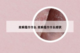 皮癬是什什么 皮癬是什什么癥狀