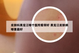 皮膚科黑龍江哪個醫(yī)院看得好 黑龍江皮膚病哪里最好