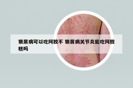銀屑病可以吃阿膠不 銀屑病關(guān)節(jié)炎能吃阿膠糕嗎