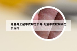 兒童身上起牛皮癬怎么辦 兒童牛皮膚癬該怎么治療