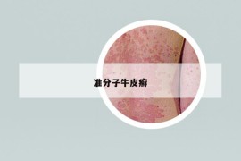 準(zhǔn)分子牛皮癬