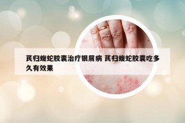 芪歸蝮蛇膠囊治療銀屑病 芪歸蝮蛇膠囊吃多久有效果