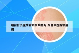 煙臺什么醫(yī)生看銀屑病最好 煙臺中醫(yī)院銀屑病