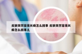 皮膚突然容易長癬怎么回事 皮膚突然容易長癬怎么回事兒