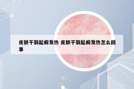 皮膚干裂起癬發(fā)熱 皮膚干裂起癬發(fā)熱怎么回事