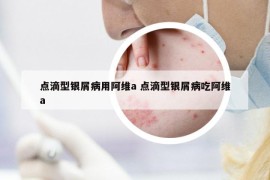 點滴型銀屑病用阿維a 點滴型銀屑病吃阿維a