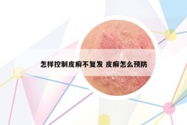 怎樣控制皮癬不復(fù)發(fā) 皮癬怎么預(yù)防