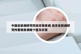 中國(guó)皮膚病研究院南京銀屑病 南京皮膚病研究所看銀屑病哪個(gè)醫(yī)生厲害
