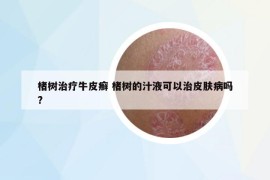 楮樹(shù)治療牛皮癬 楮樹(shù)的汁液可以治皮膚病嗎?