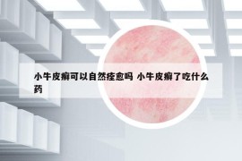小牛皮癬可以自然痊愈嗎 小牛皮癬了吃什么藥