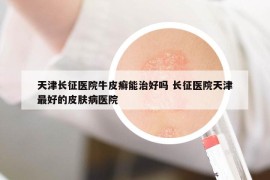 天津長征醫(yī)院牛皮癬能治好嗎 長征醫(yī)院天津最好的皮膚病醫(yī)院