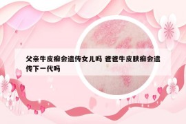 父親牛皮癬會(huì)遺傳女兒?jiǎn)?爸爸牛皮膚癬會(huì)遺傳下一代嗎