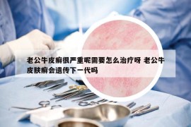 老公牛皮癬很嚴(yán)重呢需要怎么治療呀 老公牛皮膚癬會遺傳下一代嗎
