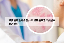 銀屑病不治療會(huì)怎么樣 銀屑病不治療會(huì)越來(lái)越嚴(yán)重嗎
