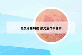 黑光冶銀屑病 黑光治療牛皮癬